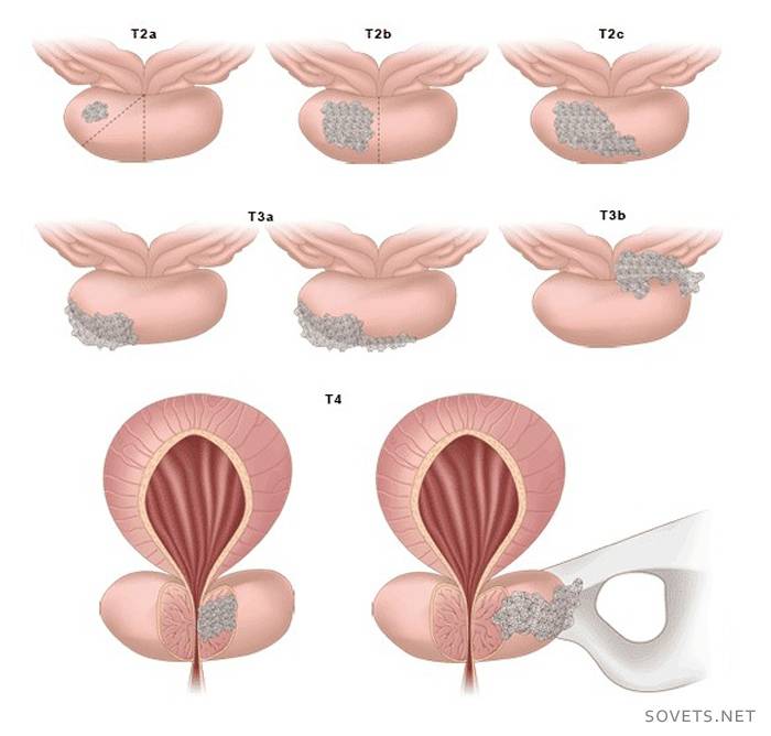 Medicamentos para el adenoma de próstata.