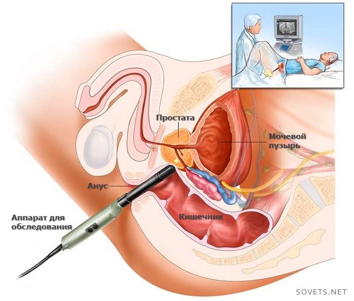 Tratamiento quirúrgico del adenoma de próstata.