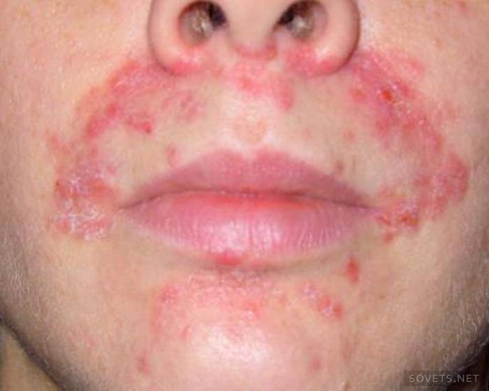 localização de focos de dermatite seborreica