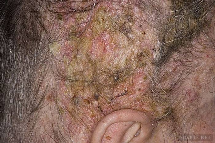 uma forma complexa de dermatite seborreica