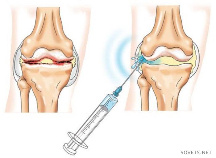 administración intraarticular de la droga