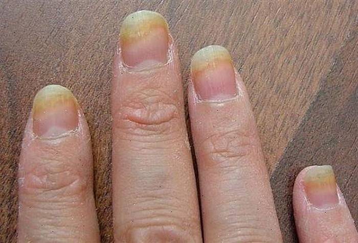 Danos nas unhas