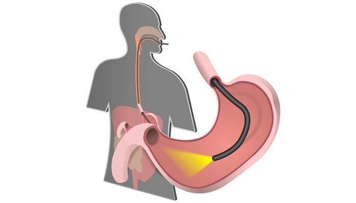 Endoskopia pre diagnostiku gastroduodenitídy