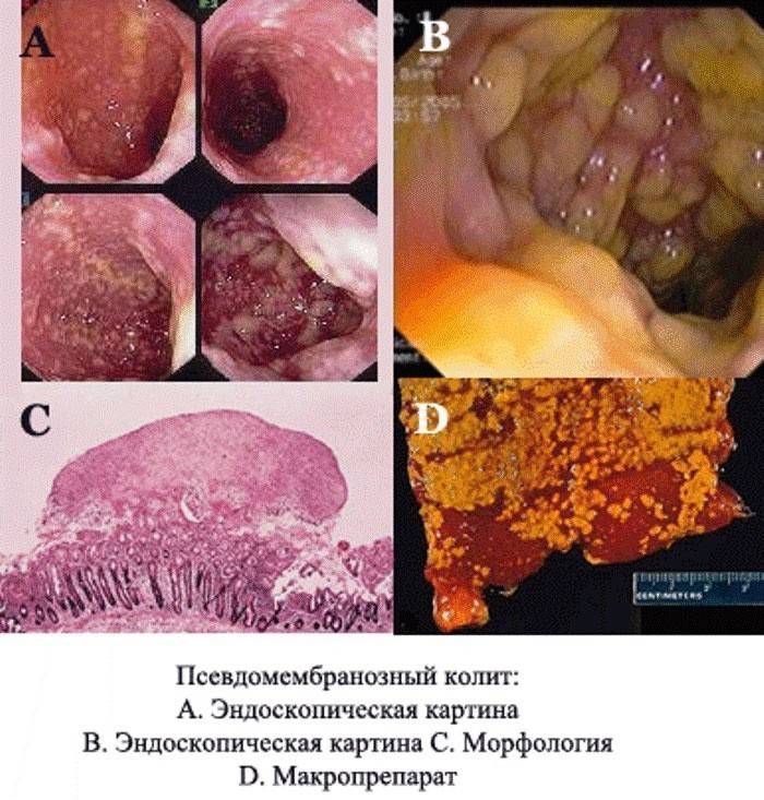 Colitis seudomembranosa: la formación de depósitos fibróticos.