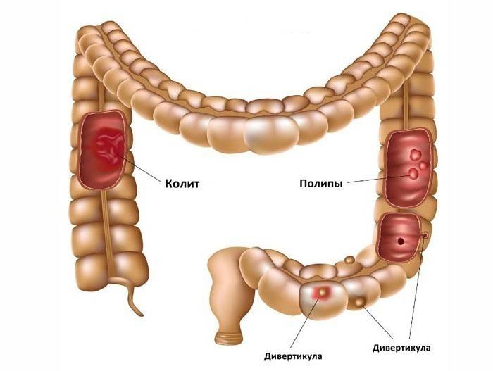 La colitis aguda se desarrolla bajo la influencia de muchas causas.
