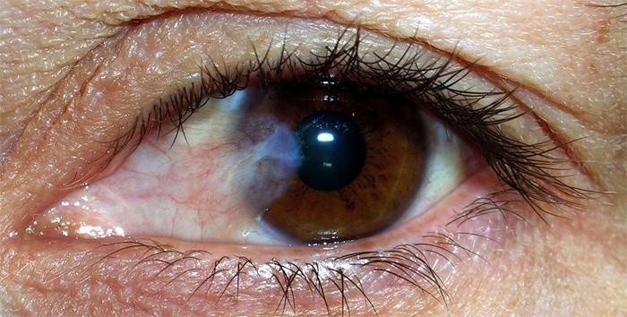 Doença ocular conjuntivite
