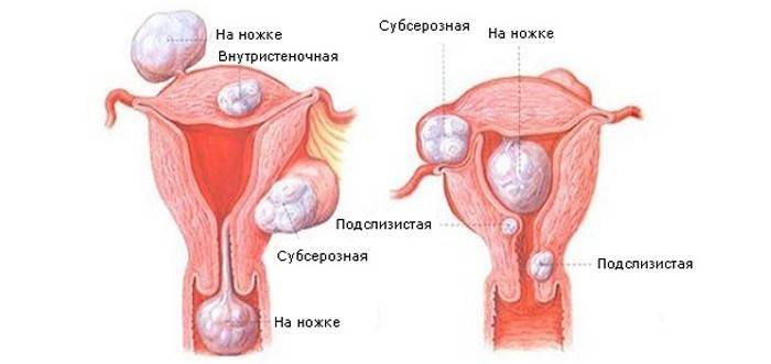 Fibroma uterino