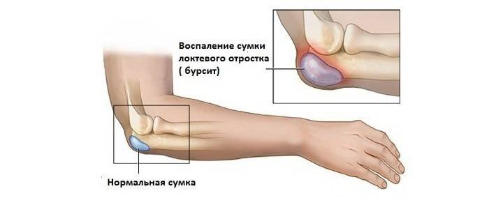 Inflamação do processo ulnar