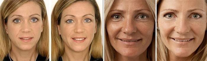 Mulheres antes e depois da aplicação de Solcoseryl
