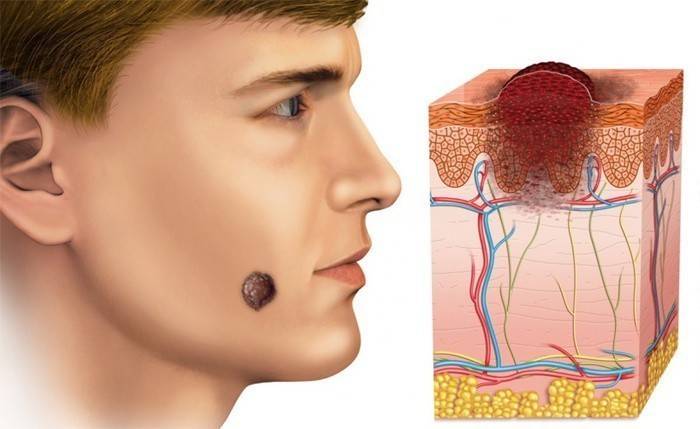 Carcinoma basocelular