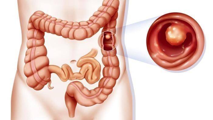Poliposis intestinal