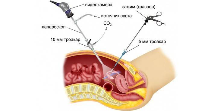 Procedimento de laparoscopia