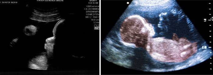 Ultrasonido del abdomen a las 39 semanas de gestación.
