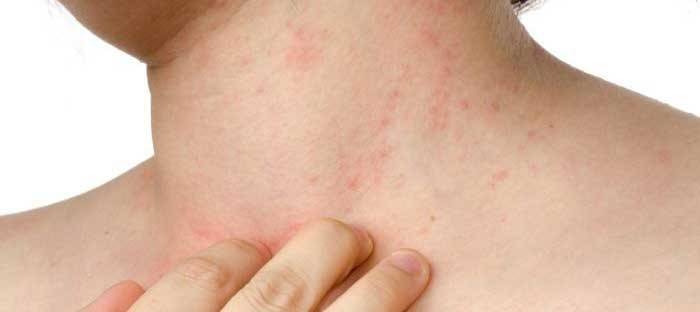 Tratamento da psoríase no corpo