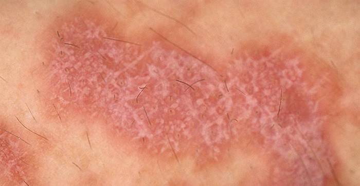 Lichen planus na koži