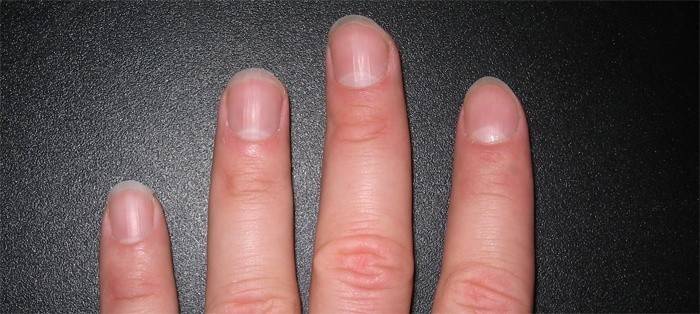 Peeling cerca de las uñas