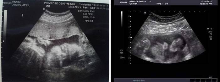 Ultrazvuk plodu po 30 týždňoch tehotenstva