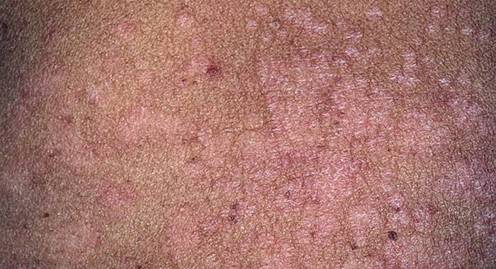 Dermatose pitiríase