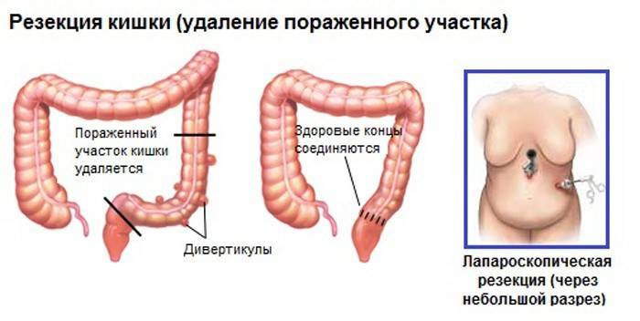 Resekcia čreva