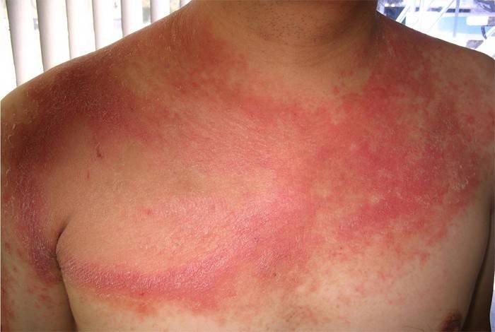 Dermatomicose no corpo