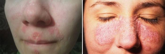 Psoríase no nariz e olhos de uma mulher