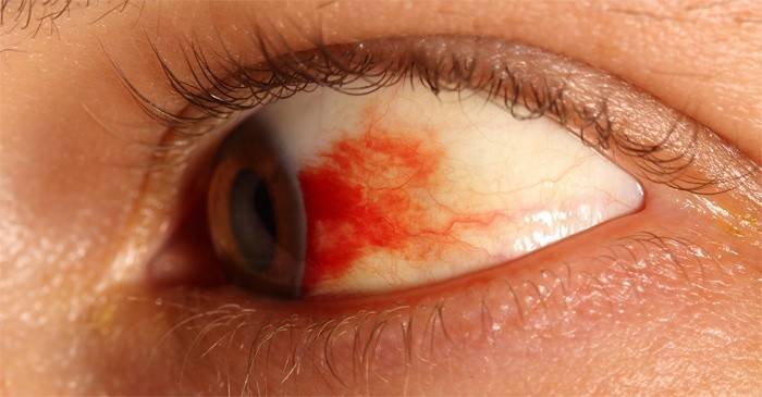 Doença ocular