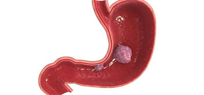 Tumor en el estómago