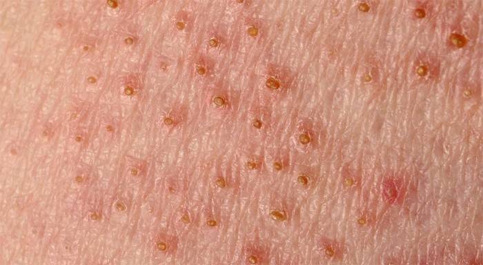 Pityriasis versicolor na ľudskej koži