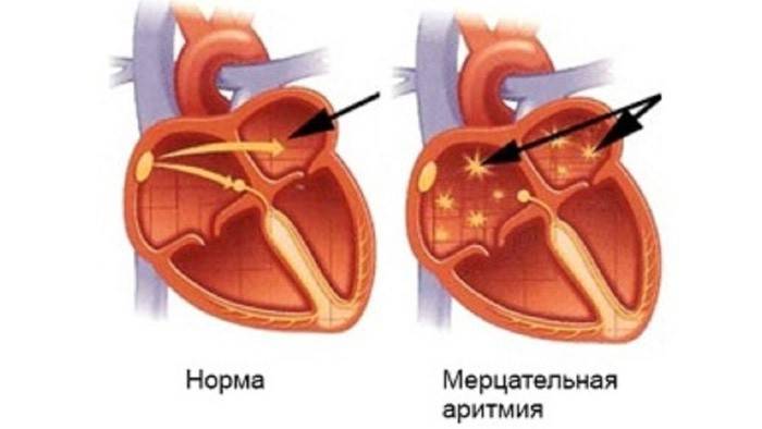 Fibrilação atrial