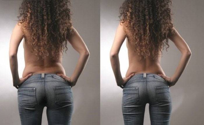 Menina emagreceu com ozoterapia