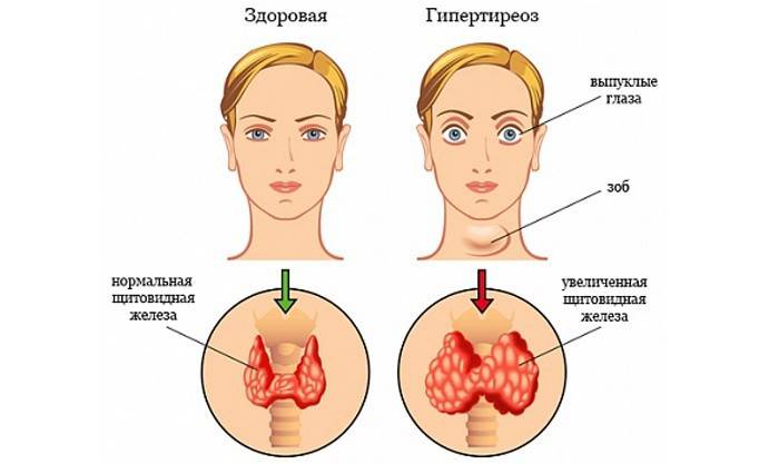 Comparación de una tiroides sana y el hipertiroidismo