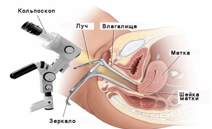 Como fazer uma biópsia cervical com erosão