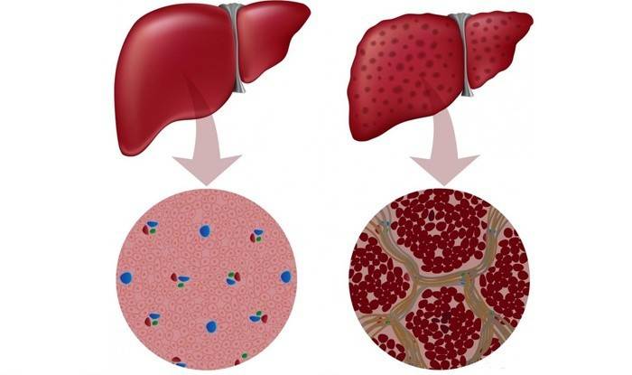Cirrosis
