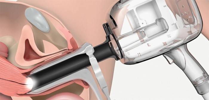¿Cómo se realiza una colposcopia extendida del cuello uterino?
