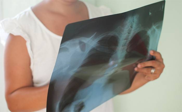Diagnóstico de tuberculose pulmonar