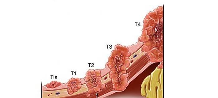Etapas del cáncer gástrico