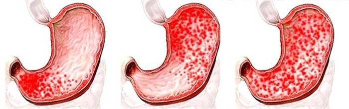 Druhy gastroduodenitídy