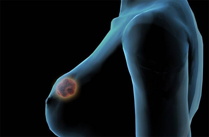 Fibroadenoma de mama