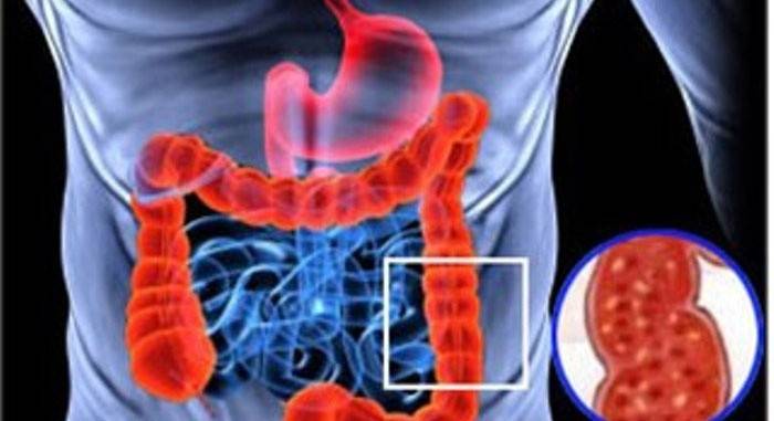 Con la desnutrición, se produce colitis atrófica.