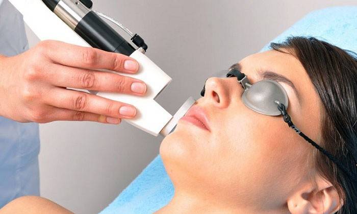 Depilação a laser