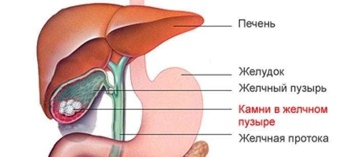 Ako vyzerá ochorenie žlčníkových kameňov?