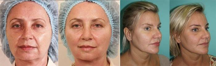 Antes y después de la extracción de los pliegues nasolabiales