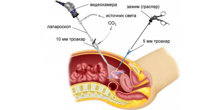 Procedimiento de laparoscopia