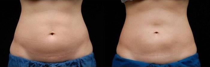 Abdômen antes e depois do ozônio