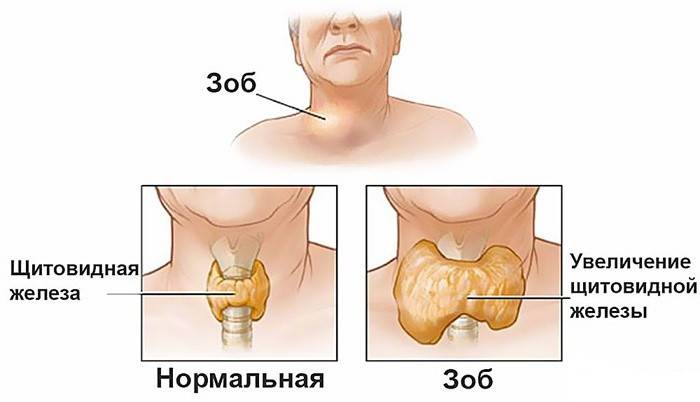 Bocio nodular