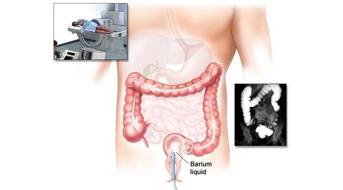 Irrigoscopia intestinal