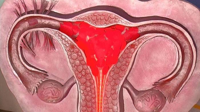 Congestión endometrial abundante