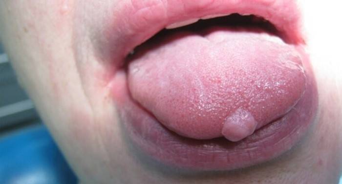 Neoplasia en el idioma