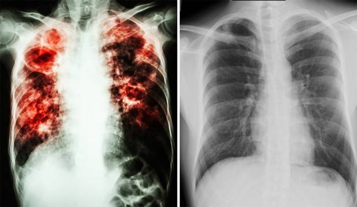 Sinal de tuberculose