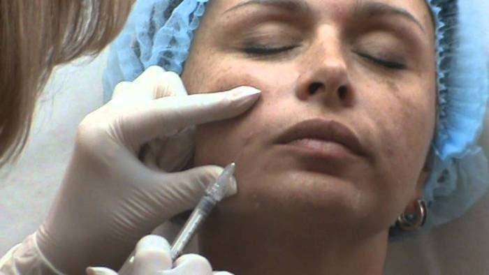 Lipofilling elimina las arrugas.